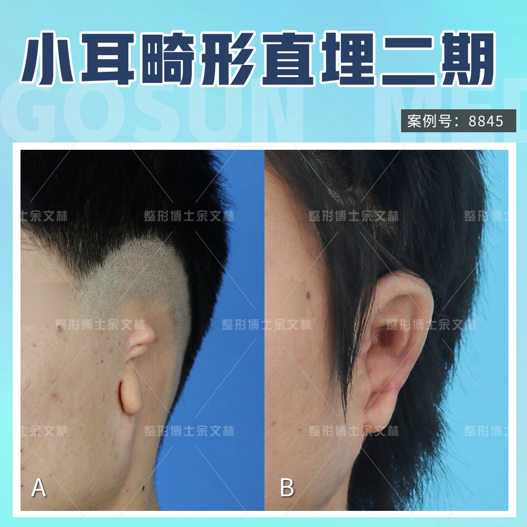 皮瓣不断蒂：皮瓣断蒂后多久可以正常上班 